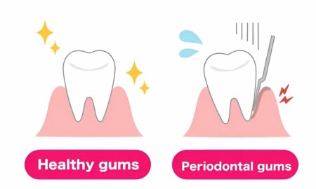 Healthy Gums vs Periodontal Gums