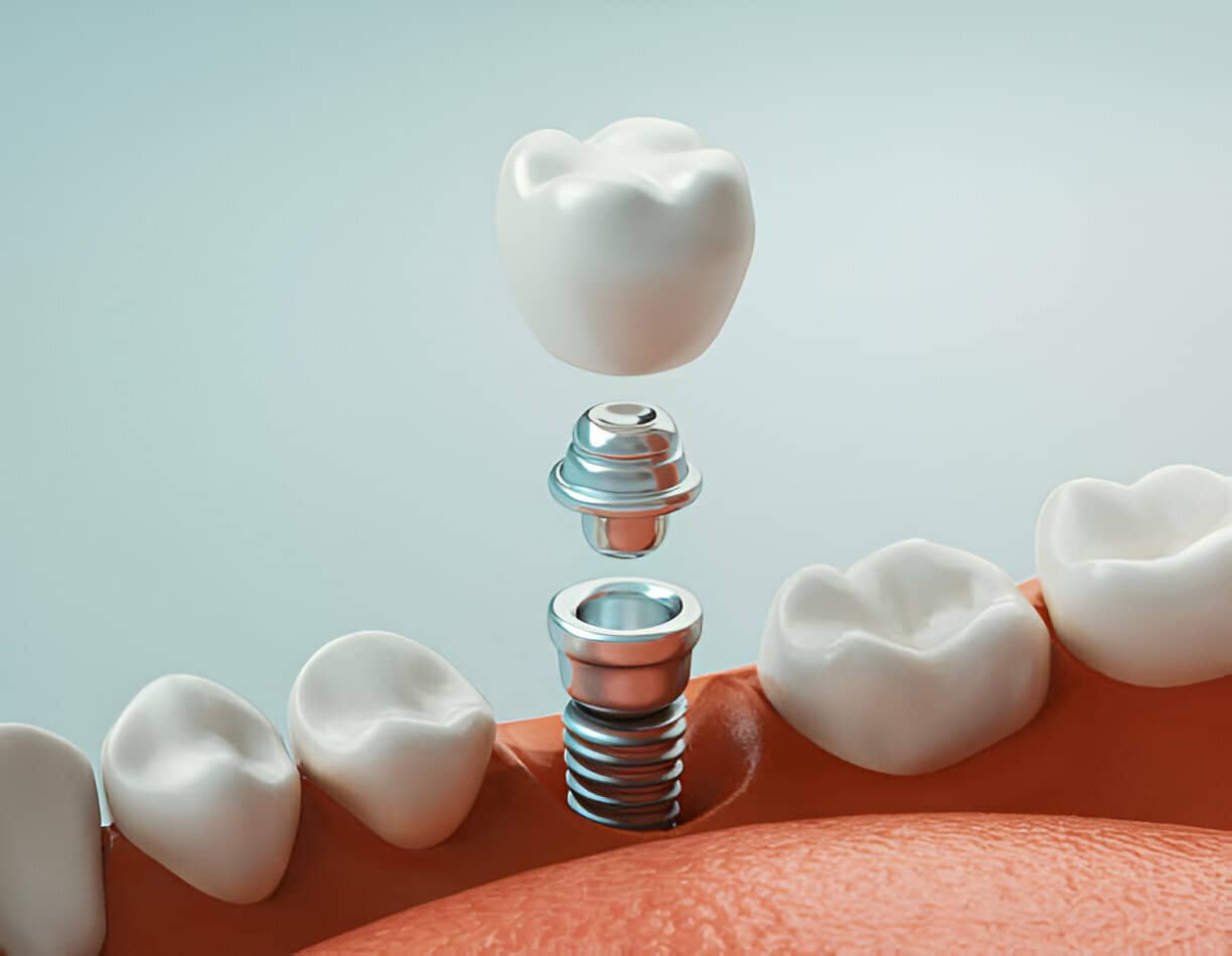 Does Dental Insurance Cover Dental Implants?