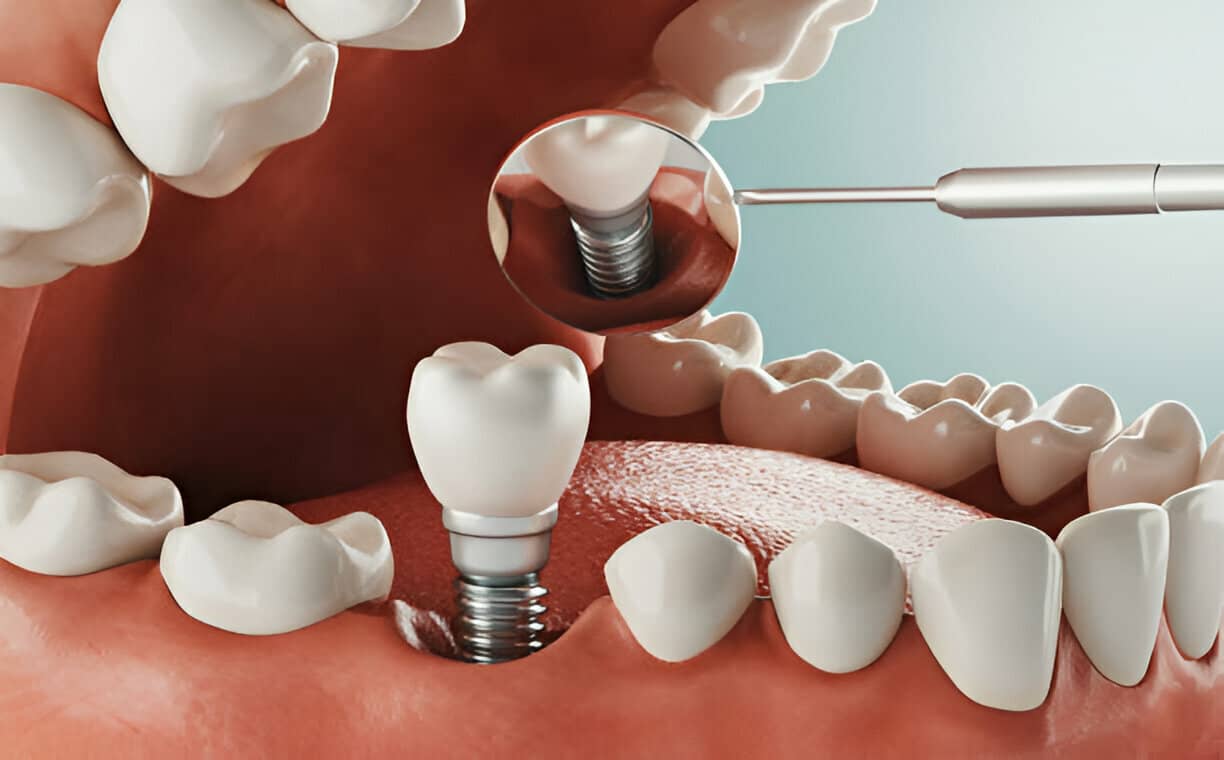 Worried About Dental Implant Pain? Here's What to Expect